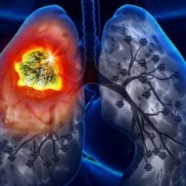 Les fumeurs séropositifs risquent plus de décéder d’un cancer du poumon